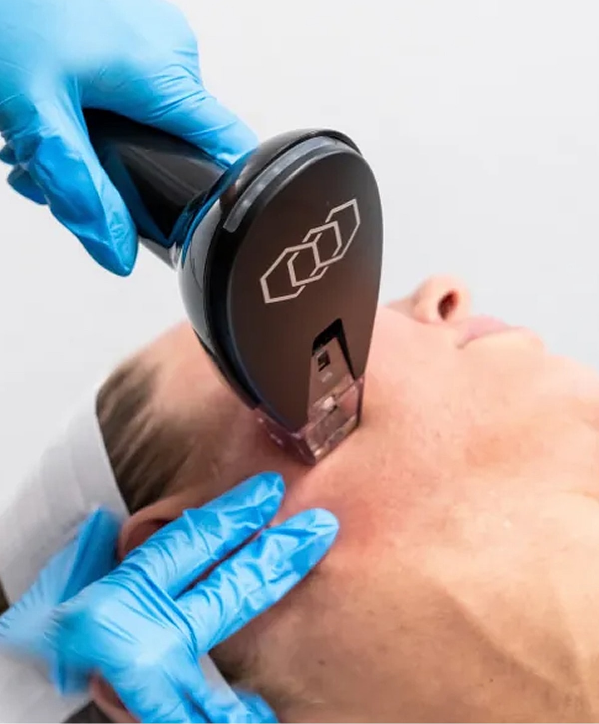 Skin treatment procedure with an applicator device.